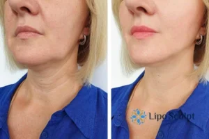 Double chin before and after Hi-Fu treatment 4 Book your double chin treatment Ripley today! We are here to help!
