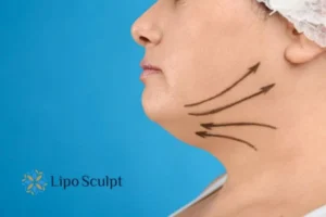 Double chin before and after Hi-Fu treatment 3 Boost your confidence with a Double chin treatment Ripley