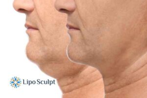 Double chin before and after Hi-Fu treatment 2 Double chin treatment Ripley from Lipo Sculpt - feel more confident today!
