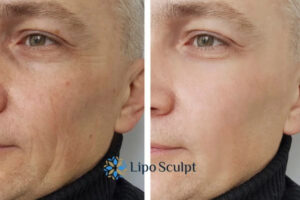 How to Fight Aging Symptoms 3 Fight Aging Symptoms Ripley With HIFU and Morpheus8 Today!