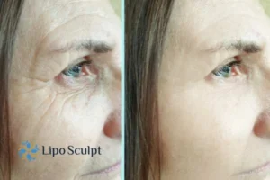 How to Fight Aging Symptoms 2 Do you want to Fight Aging Symptoms Ripley? Contact Lipo Sculpt today!