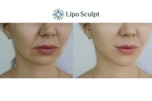 Explaining Morpheus8 And What It Can Do For You 2 Do you want to boost your self confidence? Give Morpheus8 Ripley a try today!