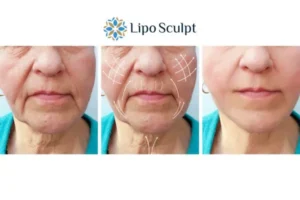Explaining Morpheus8 And What It Can Do For You 3 Boost your confidence with Morpheus8 Ripley call our team today!