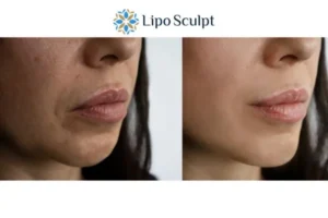Explaining Morpheus8 And What It Can Do For You 4 Morpheus8 Ripley the best results - call our team today!