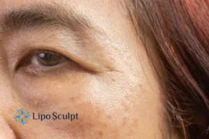 Cryopen: The Revolutionary Treatment for Age Spots Unveiled 2 Are age spots Ripley giving you low self esteem? Contact us today!