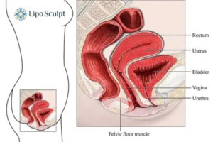 Treatment For A Leaky Bladder 2 How EM Chair treatment Ripley can help Leaky bladder issues. Read more now!