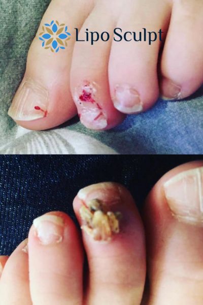 Wart removal customer results from Lipo Sculpt Ripley